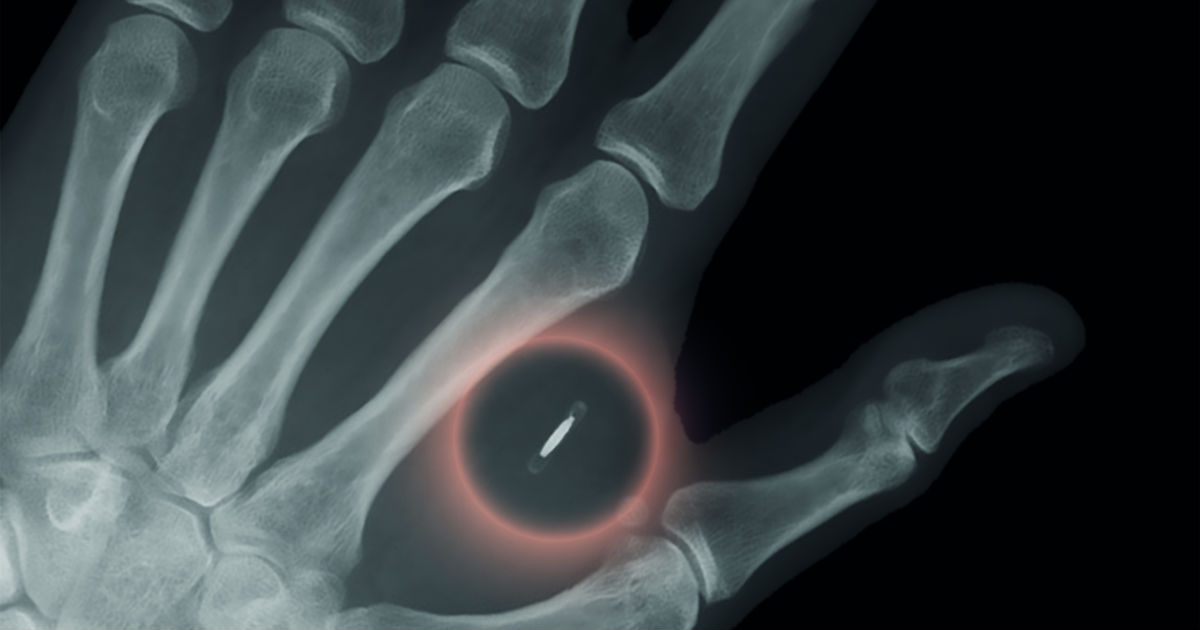Hand statt Bankkarte: Bezahlen wir demnächst mit einem in den Körper implantierten Chip? – FinanceFWD